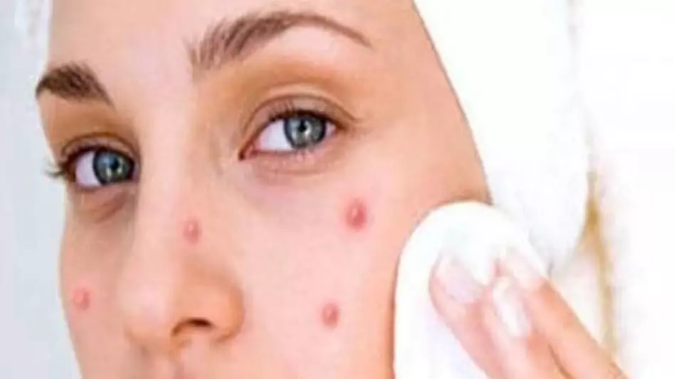 Pimple: अगर फूट गए है चेहरे के मुंहासे तो अपनाए ये तरीके