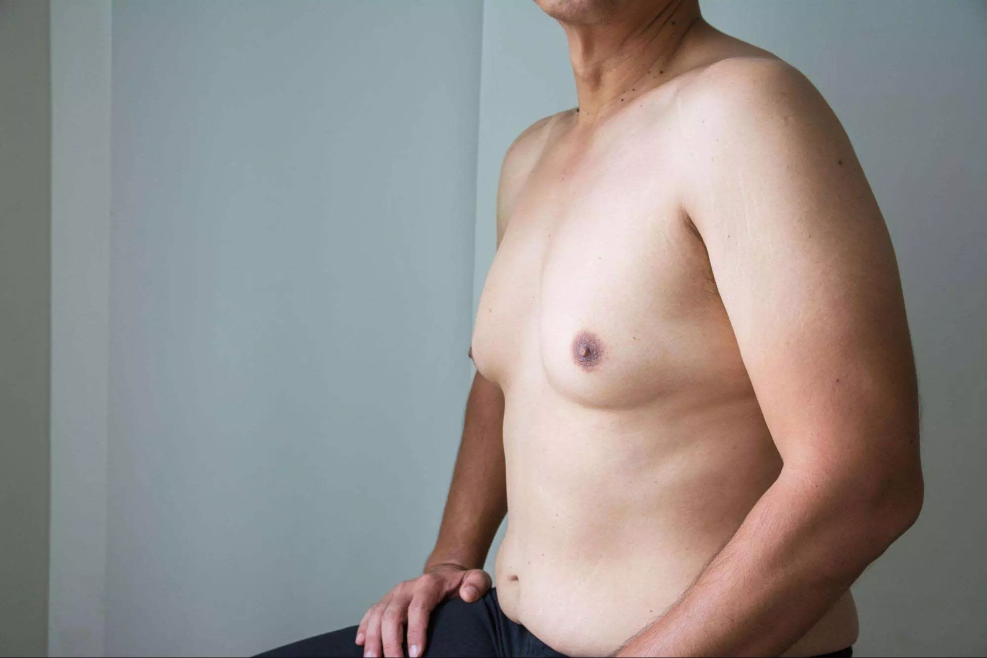 Male breasts वृद्धि सामाजिक चिंता और शर्मिंदगी का कारण