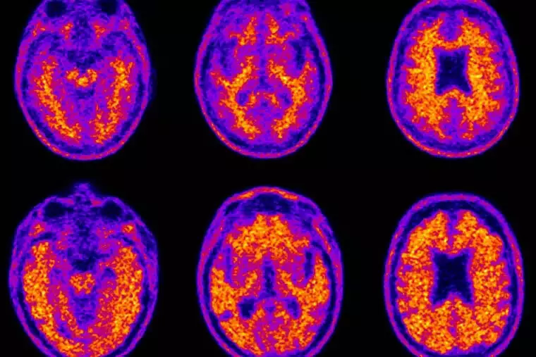 Science: FDA ने नई अल्जाइमर दवा को मंजूरी दी