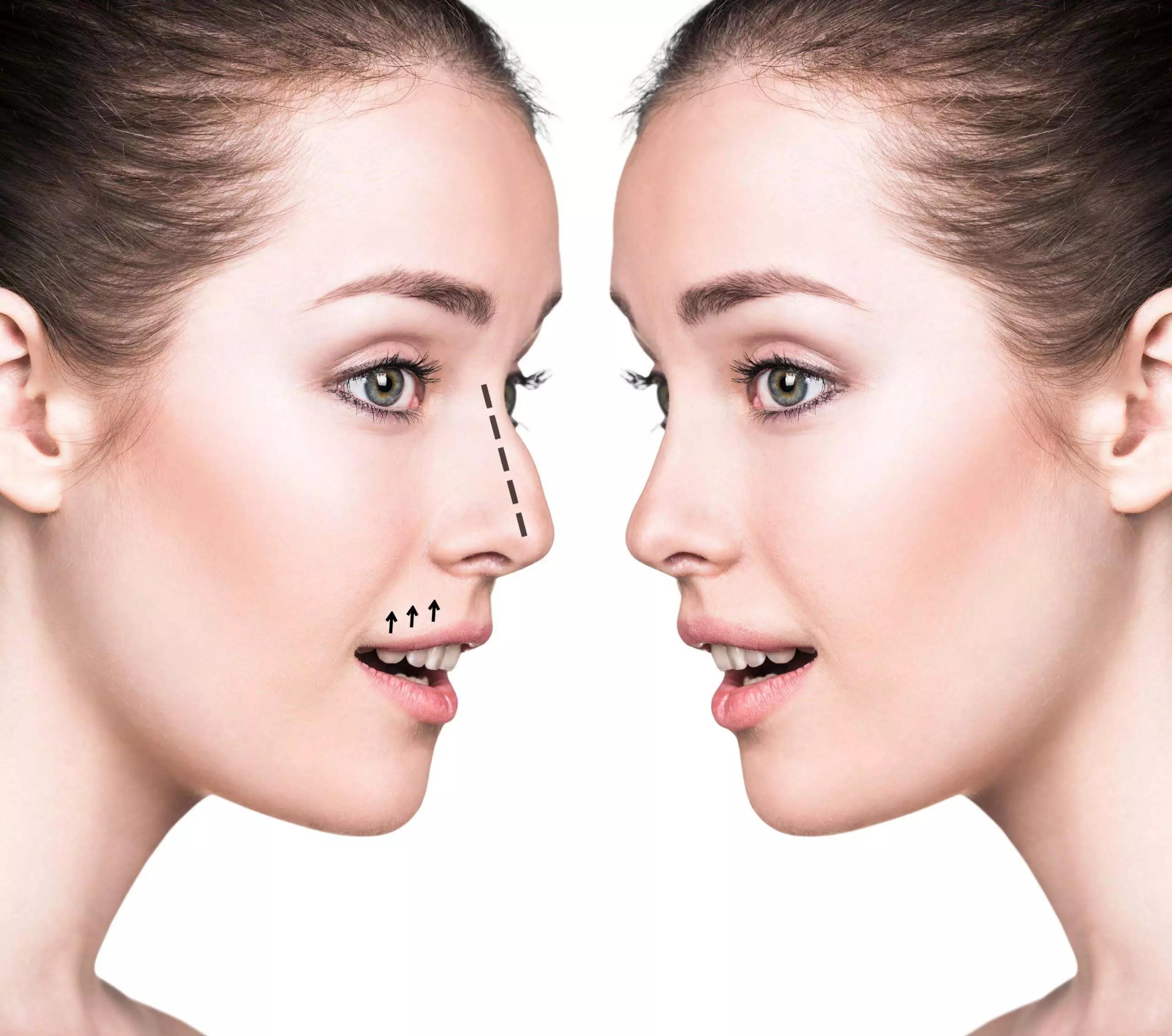 Nose surgery प्लास्टिक सर्जन एंथनी यून ने भी इसी बारे में चर्चा की