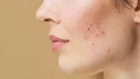 Pimples on the face: चेहरे पर पिंपल्स के लिए करें घरेलू उपाय