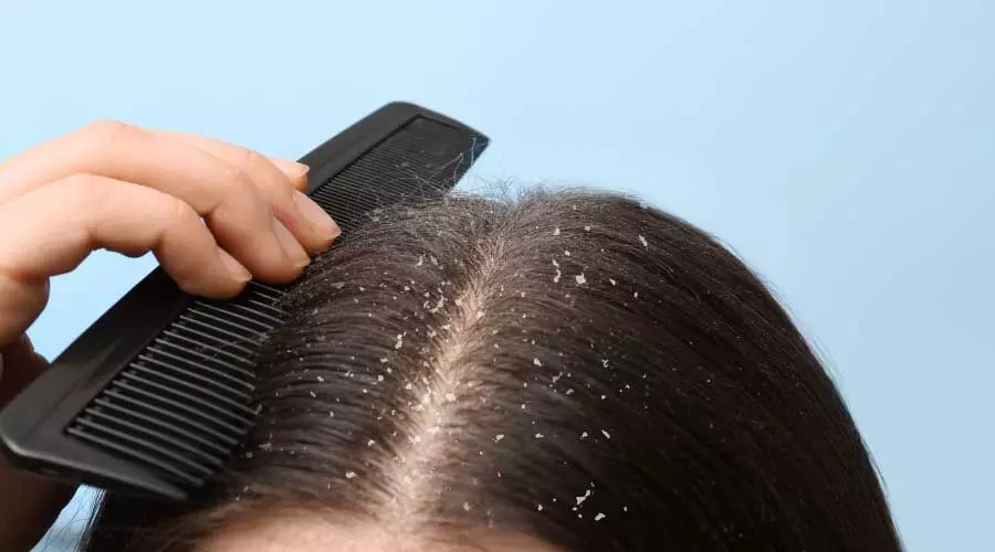 Hairy dandruff: बालों में रूसी से है परेशान तो अपनाये ये घरेलू उपाए