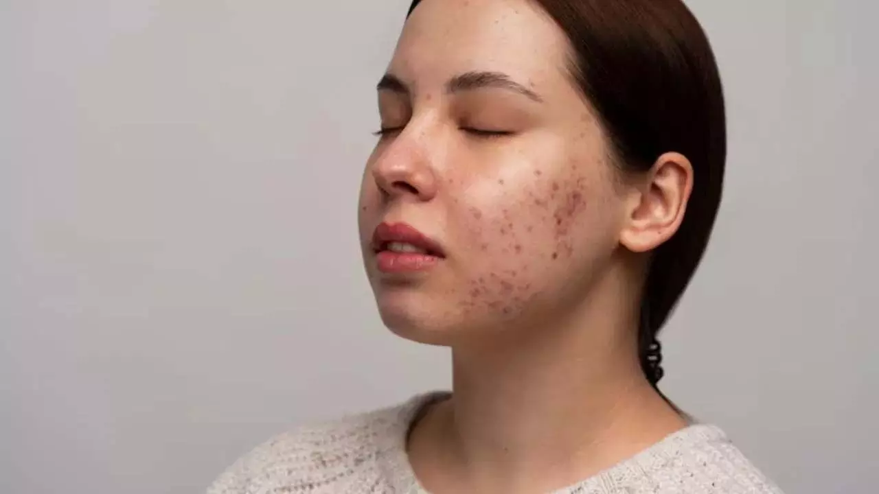 Acne and Skin Infection से बचने के लिए करें ये काम