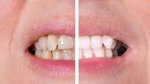 Yellow Teeth: दांतों पर जमी पीली गंदगी को हटा देंगी ये चीजें