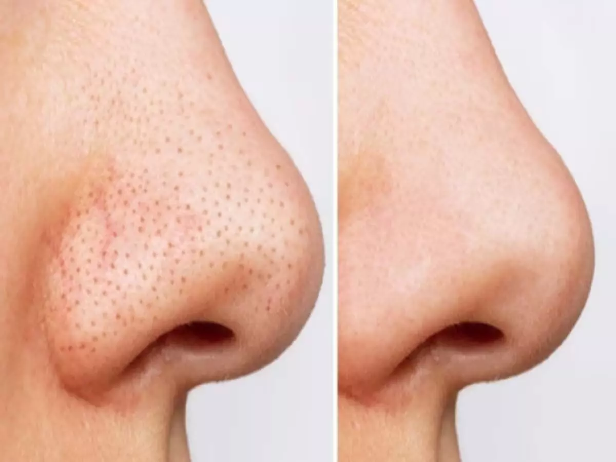 Beauty tips: नाक पर मौजूद ब्लैकहेड्स को इस तरीके से करे रिमूव