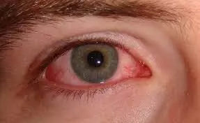 REMEDIES :  आँखों की लालिमा का घरेलू इलाज