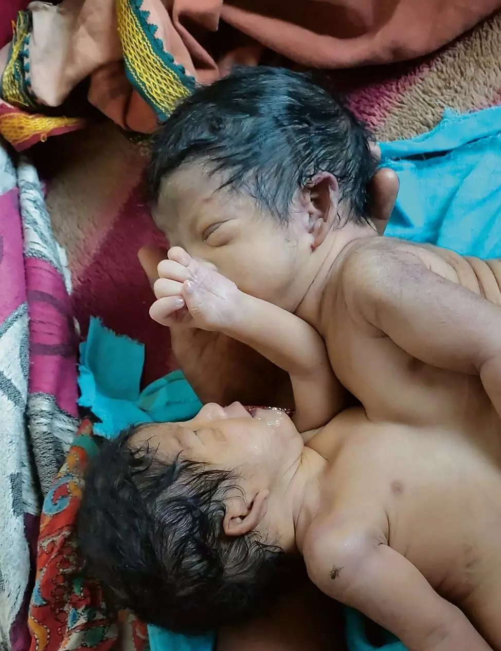 HARYANA :  अंबाला में एक ही हृदय वाले जुड़वाँ बच्चे पैदा हुए