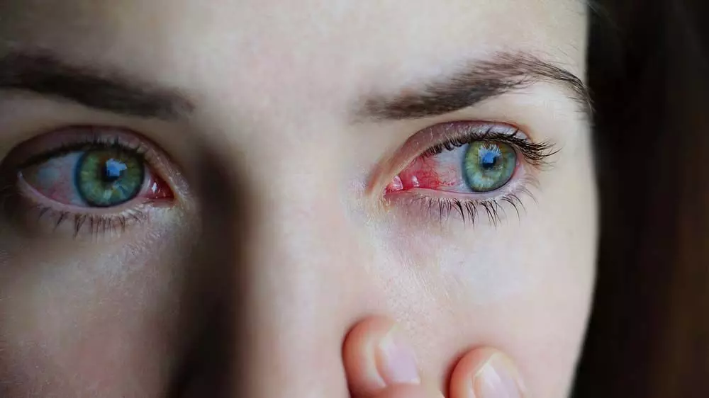 Health Care: आंखों में होने वाले कंजक्टिवाइटिस का जाने बचाव के टिप्स