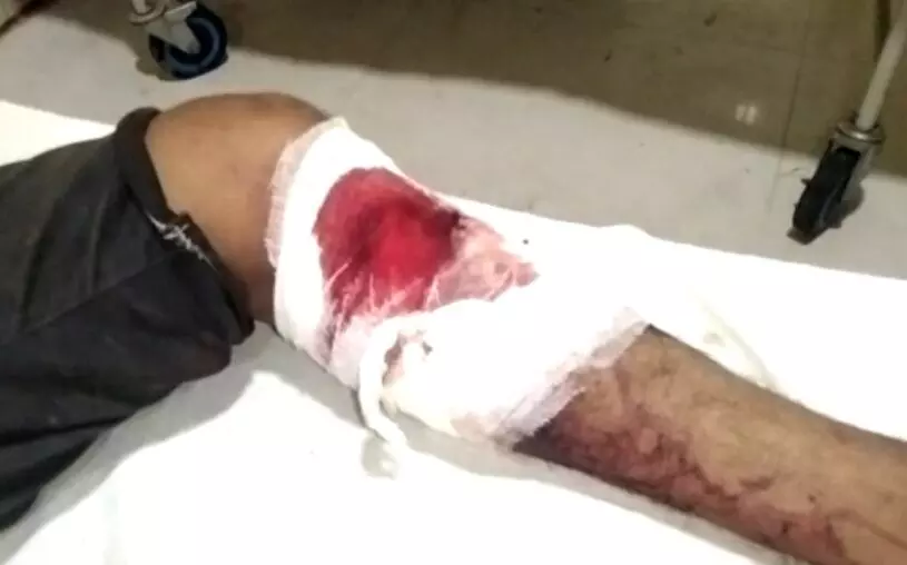 Roorkee: पुलिस की मुठभेड़ के दौरान बदमाश के पैर में लगी गोली