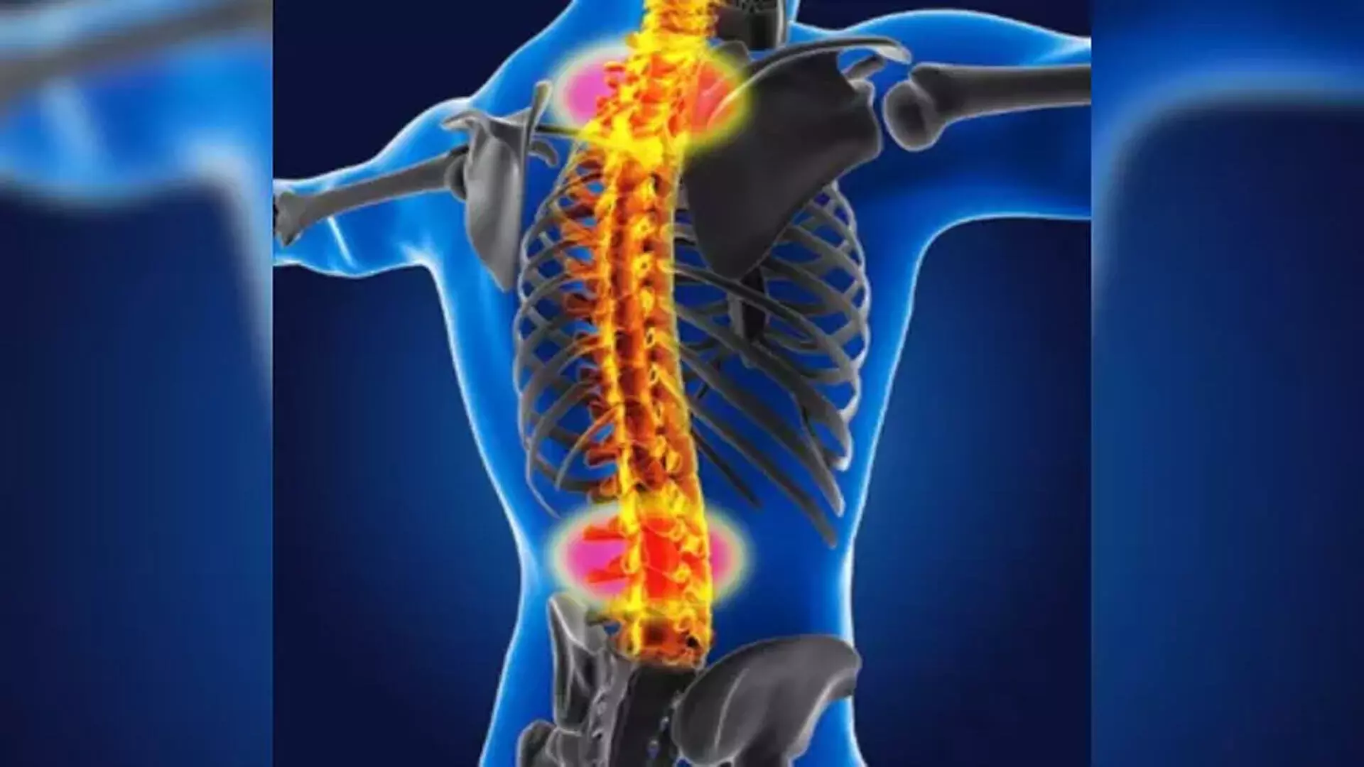 Spinal मस्कुलर अट्रोफी से लीवर की क्षति का खतरा बढ़ने की सम्भावना