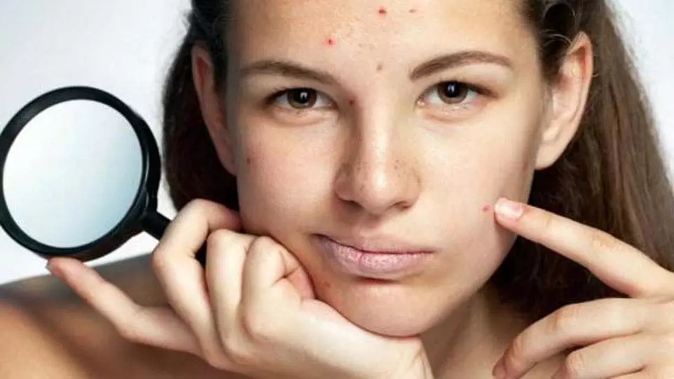 Acne and pimples को रोकने के लिए टिप्स