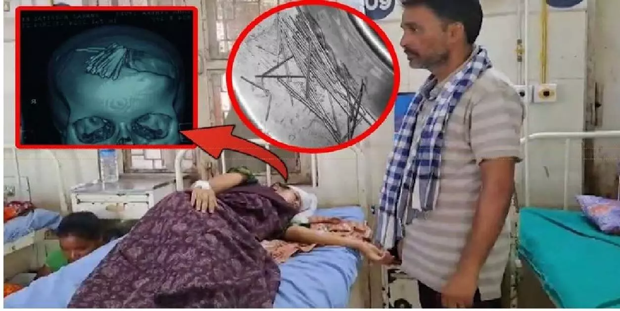 Bhubaneswar: जादू-टोने की शिकार लड़की के सिर से सर्जरी कर निकाली गईं 70 इंजेक्शन की सुइयां