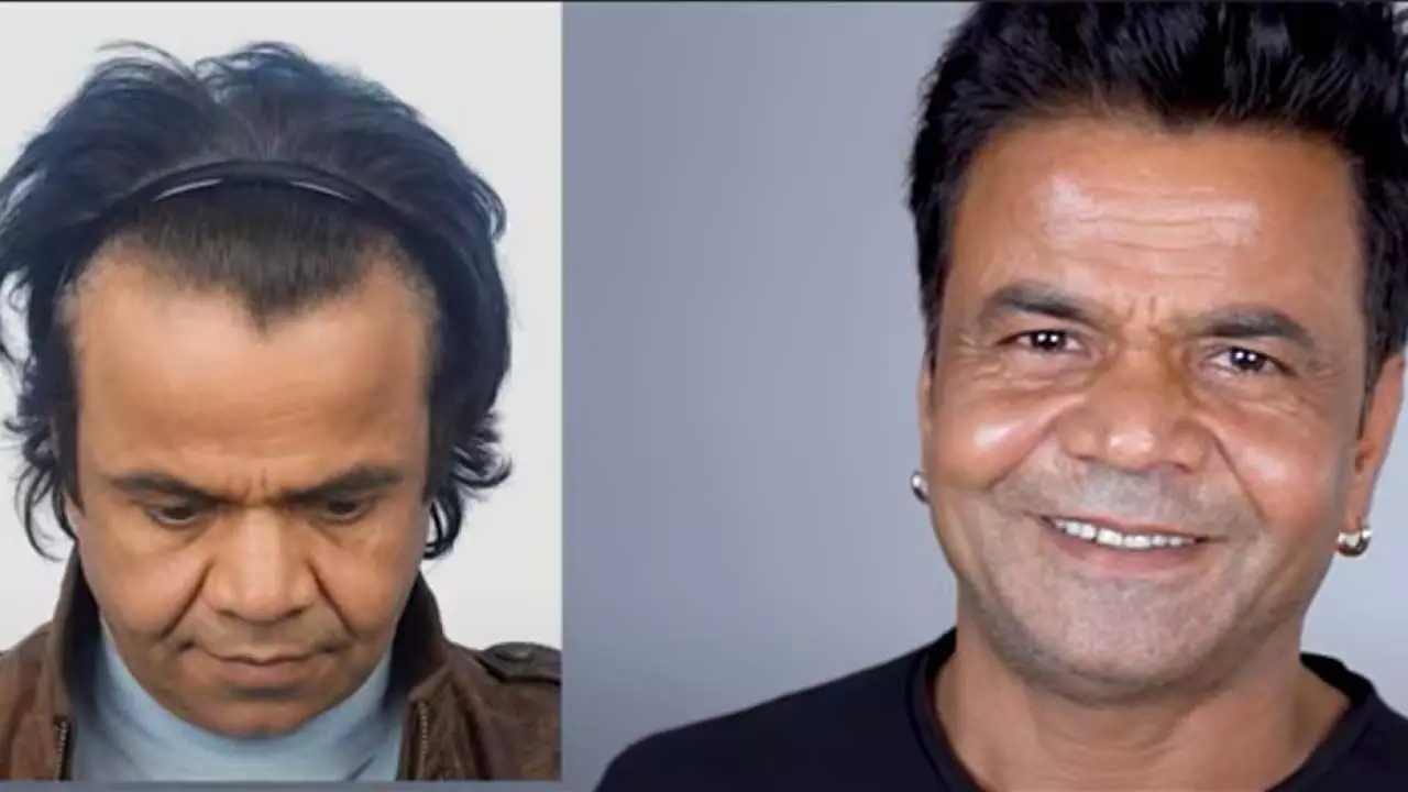 Rajpal Yadav के हेयर ट्रांसप्लांट की सर्जरी से पहले और बाद की वीडियो