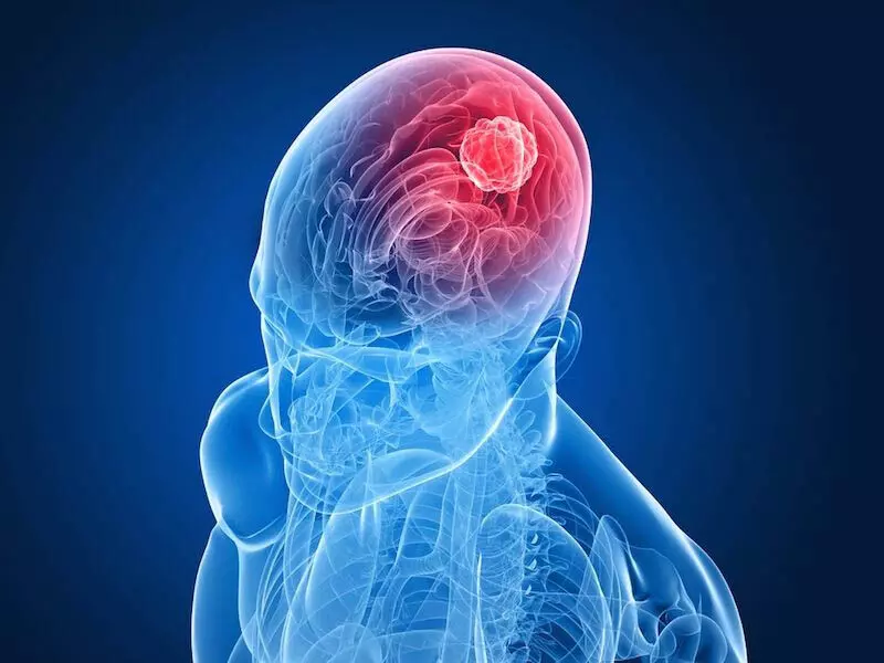इलाज करने वाली Drugs वयस्कों में निम्न-श्रेणी के मस्तिष्क में ट्यूमर