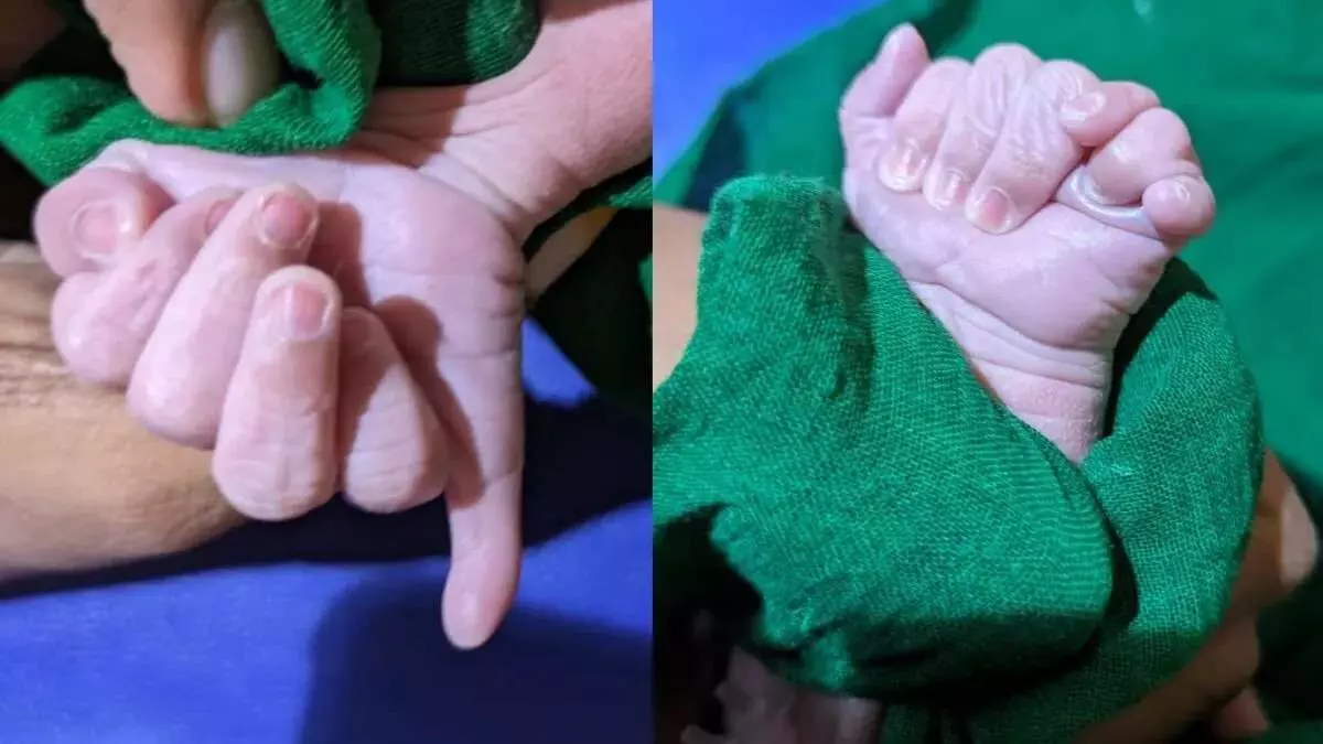 Karnataka में 25 हाथ-पैर की उंगलियों के साथ पैदा हुआ बच्चा