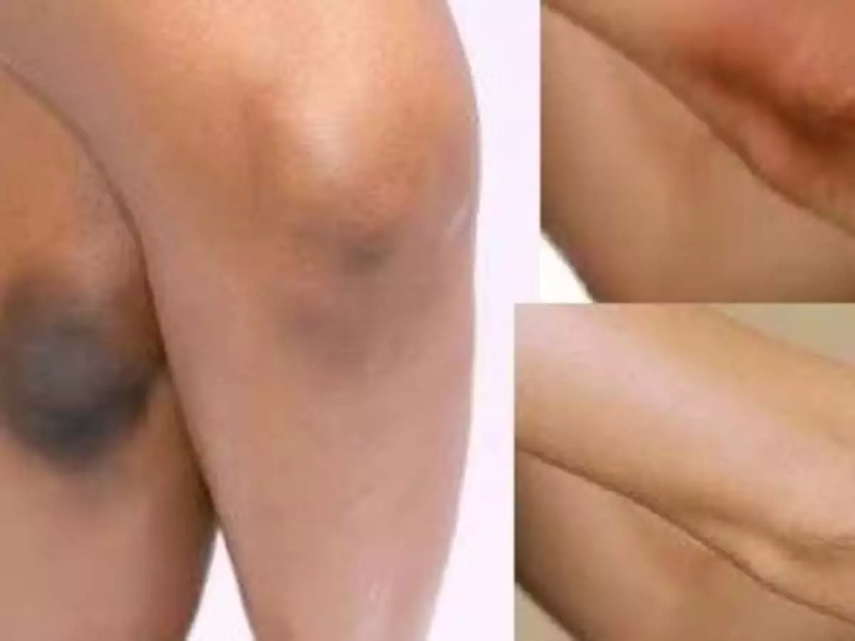 Skin care: इन उपायों से नहीं आएगी काले घुटनों और कोहनी से शर्म