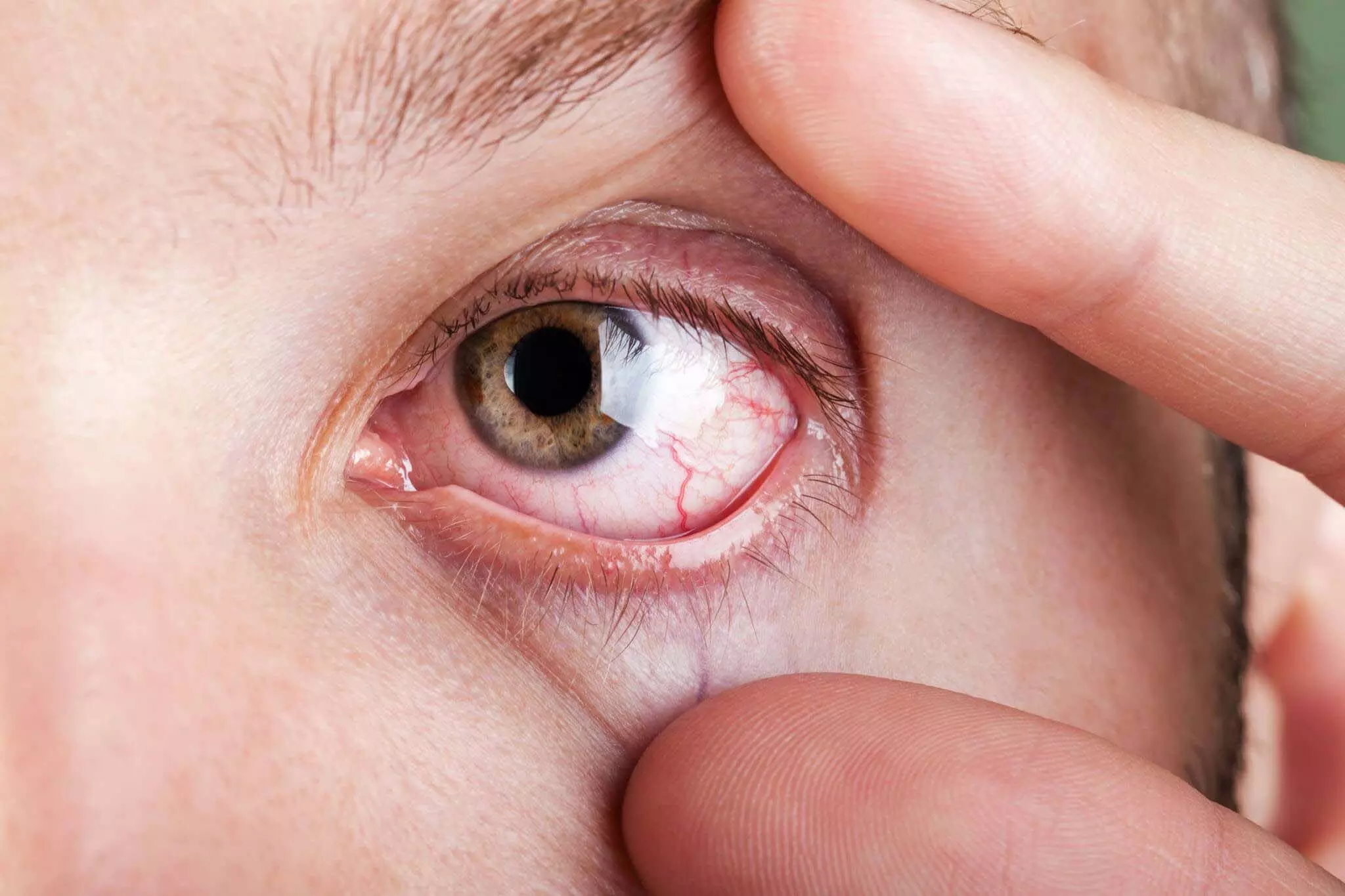 Dry Eye Syndrome रोकने के लिए सुझावों का पालन करें