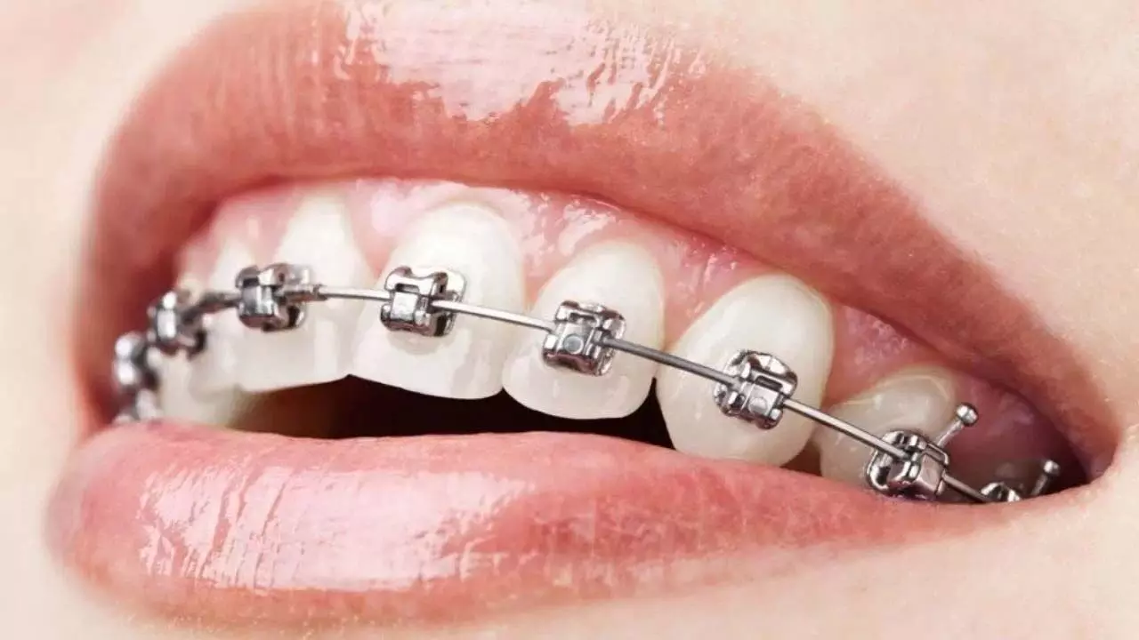 Teeth braces लगवाने के बाद जाने किन चीजों से बचना चाहिए