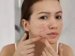 Skincare: जाने किन गलतियों के कारण चेहरे पर निकलते हैं दाने और पिंपल्स