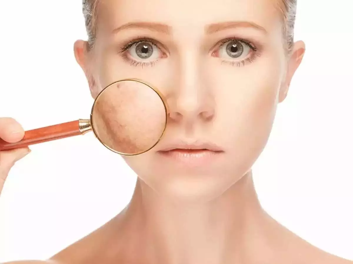 Skin care: चेहरे पर से झाइयों को दूर करने के लिए अपनाये ये नुस्खे