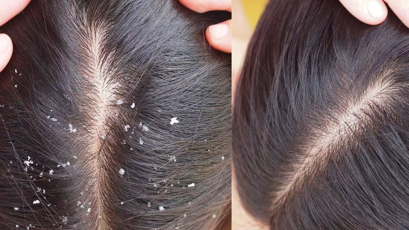 Dandruff से पाए छुटकारा करे काम ये नुस्खे