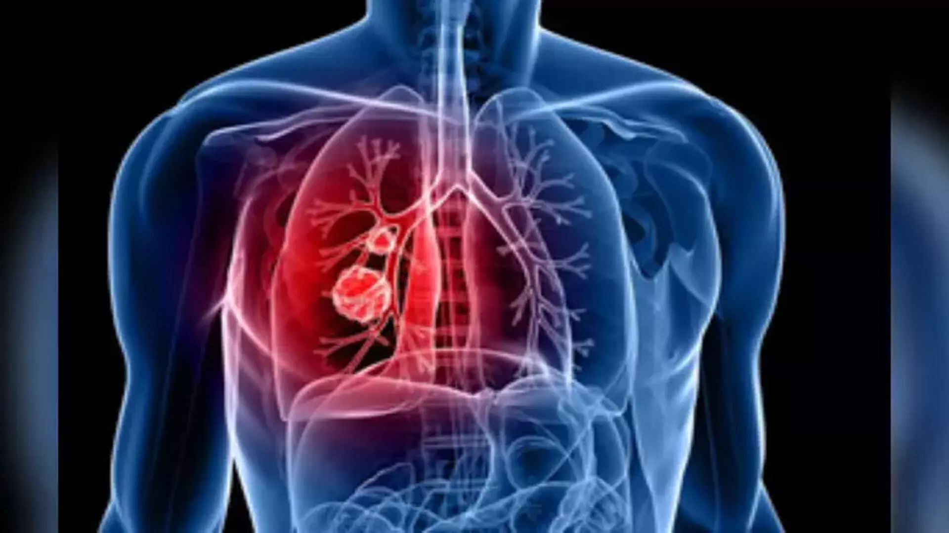 Lung cancer मस्तिष्क में फैलने वाला सबसे आम कैंसर है- विशेषज्ञ