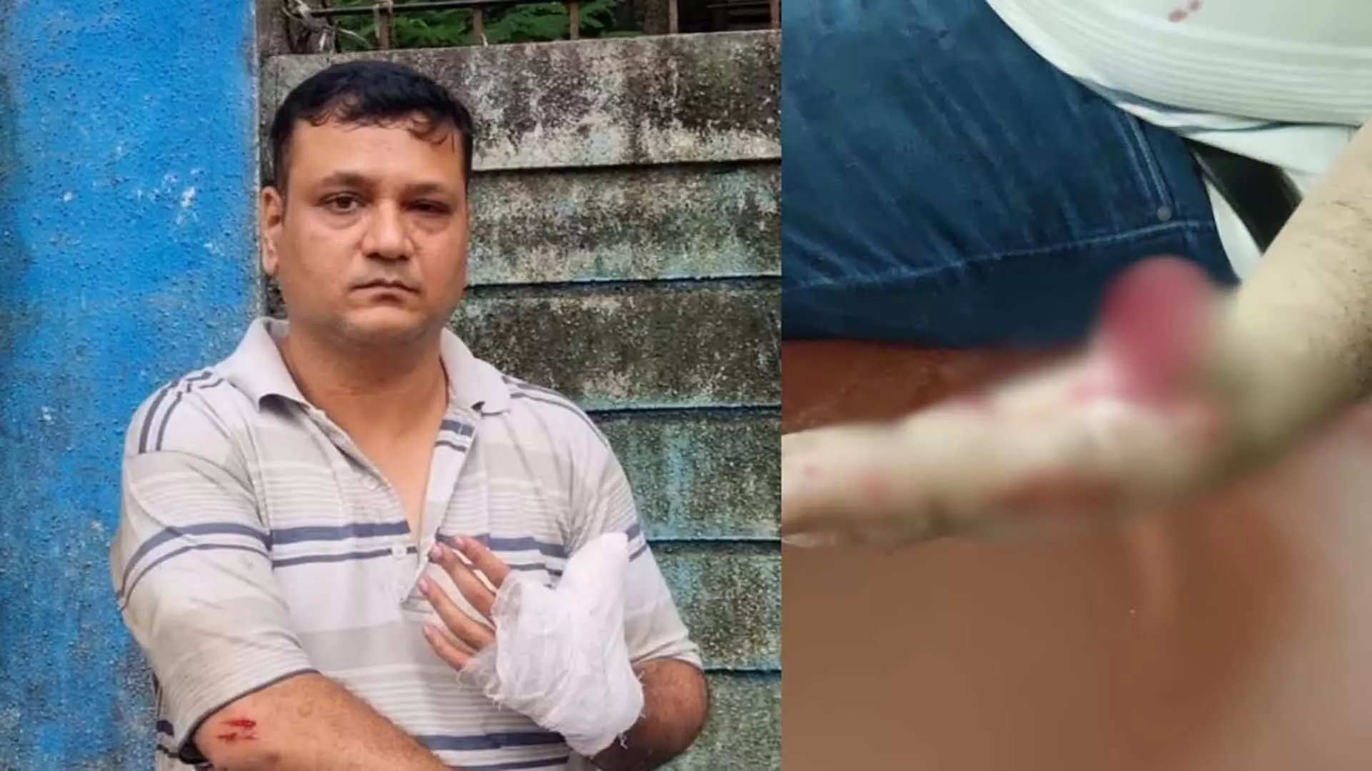 Mumbai: बहस के बाद सोसायटी के चेयरमैन ने सदस्य का अंगूठा काट दिया