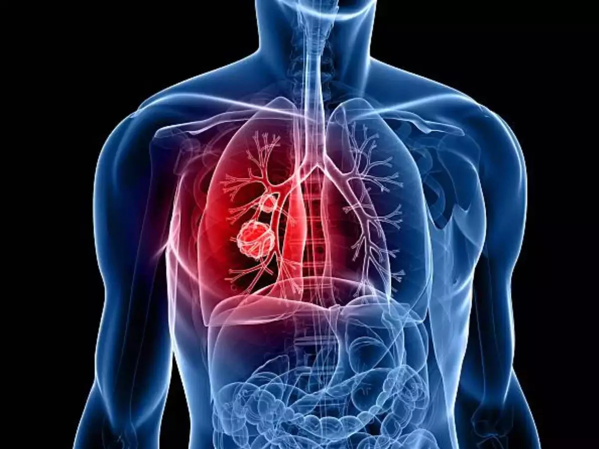 Lungs की सफाई करने से फेफड़ों के कैंसर को रोकने में मदद ?