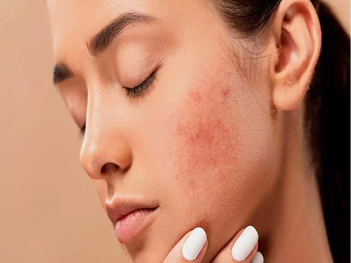 इन दिनों होते हैं ज्यादा Pimples, जाने बचाव के तरीके