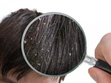 घर में रखी चीजों से पाएं dandruff से छुटकारा