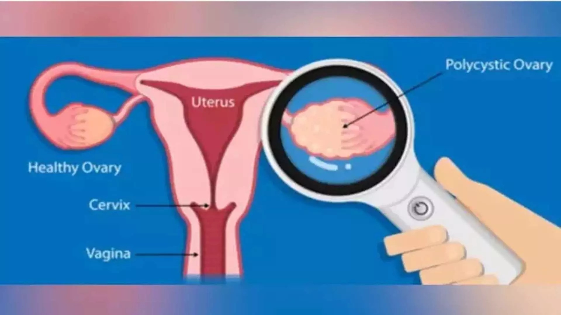 PCOS से पीड़ित महिलाओं में अव्यवस्थित खानपान का खतरा अधिक