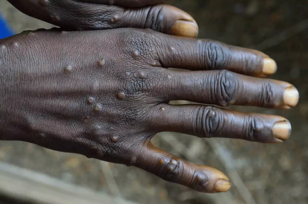 Monkeypox अब अंतरराष्ट्रीय चिंता का सार्वजनिक स्वास्थ्य आपातकाल