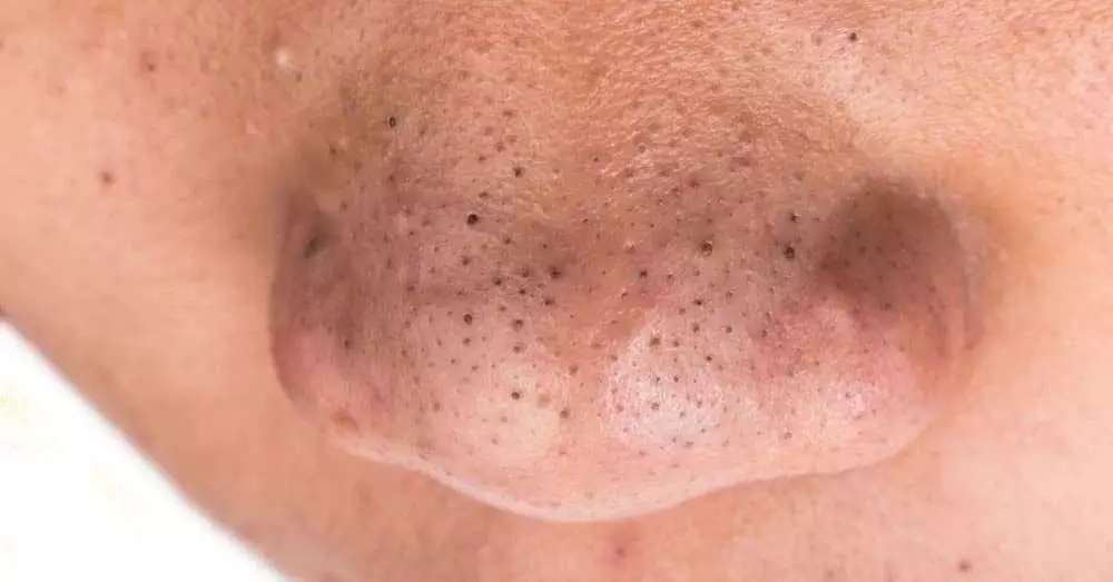 घर पर अपनी नाक से blackheads हटाने के 5  प्रभावी तरीके