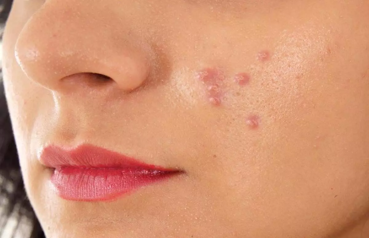 Pimples से मिलेगा छुटकारा, अपनाये ये घरेलू नुस्खे