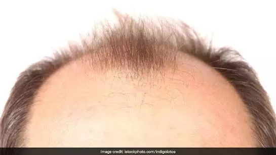 फिर से उगा देगा Hair , शैम्पू में मिलाकर बना चुकंदर और मेथी का ये लाल पानी