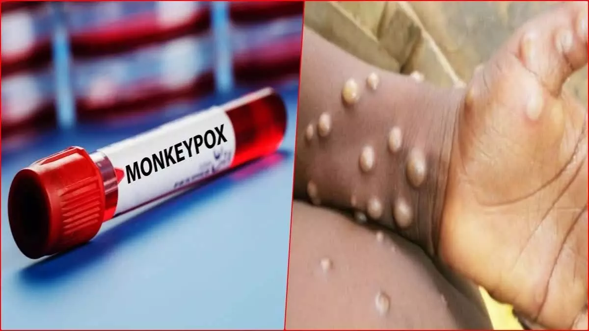 Monkeypox: भारत में एमपॉक्स का संदिग्ध मामला आया सामने, दुनियाभर में खतरा बढ़ा