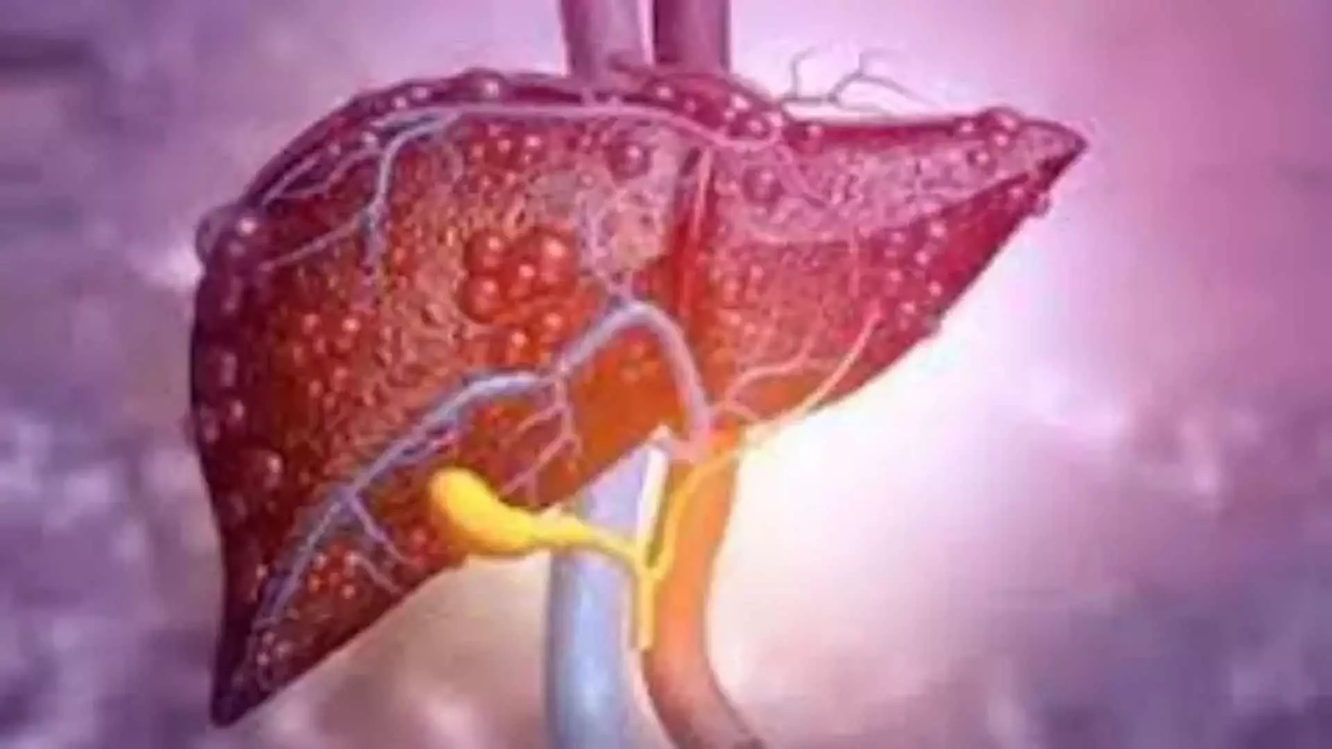 Diabetes और मोटापे से लीवर कैंसर के दोबारा होने का खतरा बढ़ जाता है- अध्ययन