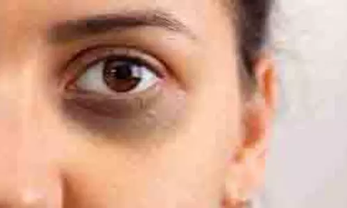 आसान उपाय से डार्क सर्कल्स को कहें अलविदा आसान उपाय से डार्क सर्कल्स को कहें अलविदा