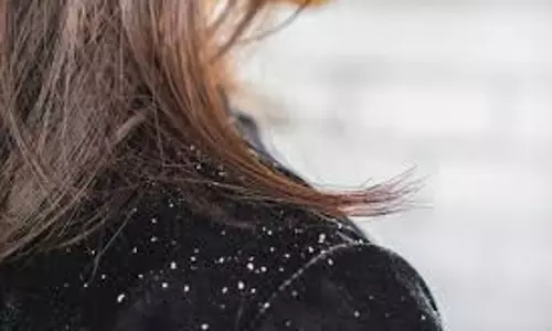 Lifestyle: बदलते मौसम में खुदको डैंड्रफ और हेयर फॉल फ्री ऐसे रखें Lifestyle: बदलते मौसम में खुदको डैंड्रफ और हेयर फॉल फ्री ऐसे रखें