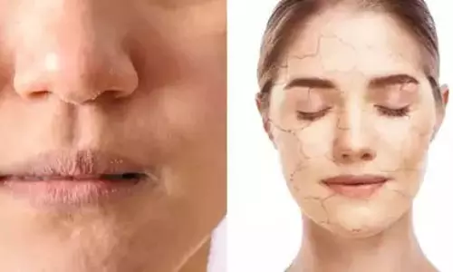 सर्दियों से पहले त्वचा फटने लगती