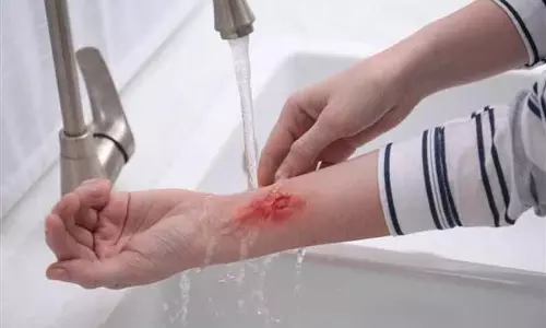 Hospitals में जलने और अन्य चोटों के 80 से अधिक मामले सामने आए Hospitals में जलने और अन्य चोटों के 80 से अधिक मामले सामने आए