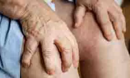 Health: इन टिप्स को अपनाने से गठिया के दर्द से मिलेगी राहत