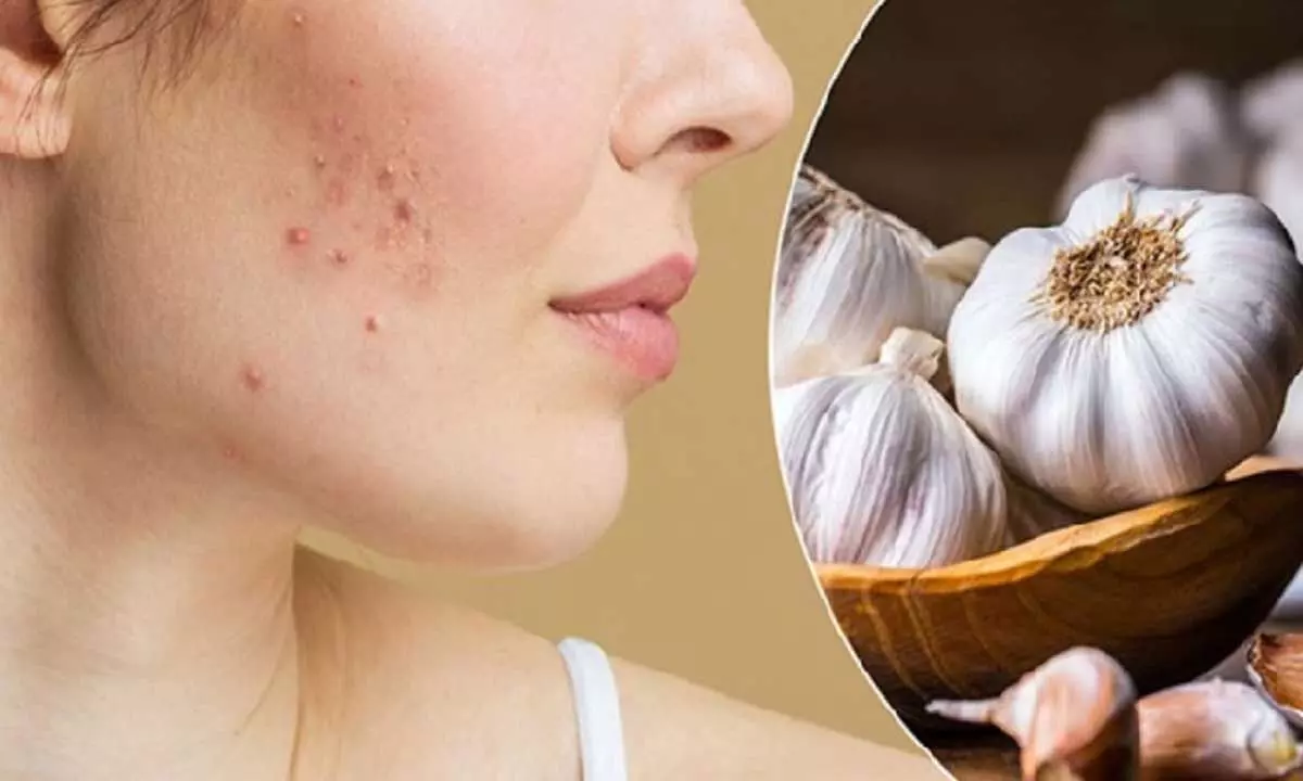 Pimples के इलाज के लिए लहसुन का उपयोग करने के 4 DIY तरीके