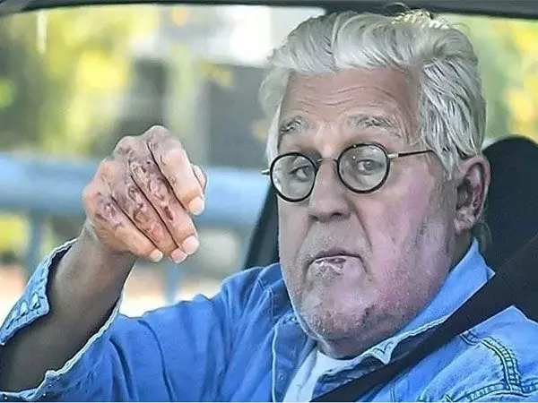 Jay Leno को पहाड़ी से नीचे गिरने के बाद आंख में चोट लगी