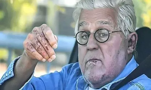 Jay Leno को पहाड़ी से नीचे गिरने के बाद आंख में चोट लगी