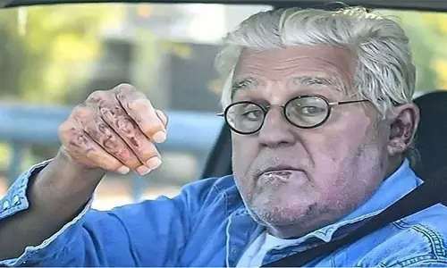 पहाड़ी से नीचे गिरने से Jay Leno की आंख में लगी चोट