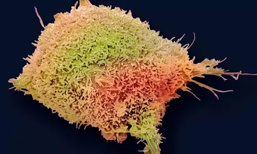 युवा महिलाओं में Servical Cancer से होने वाली मौतों में भारी कमी आई- अध्ययन