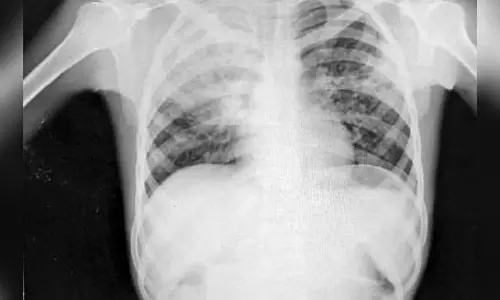 Aligarh: लंग्स संक्रमण के केस आठ गुना रफ्तार से बढ़ रहे