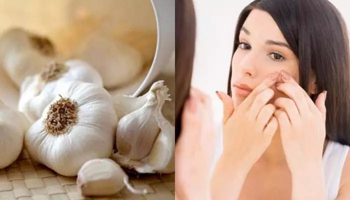 Beauty tips : लहसुन से करें अपनी त्वचा की देखभाल