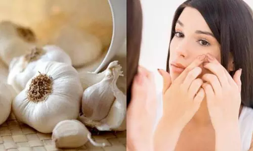 Beauty tips : लहसुन से करें अपनी त्वचा की देखभाल